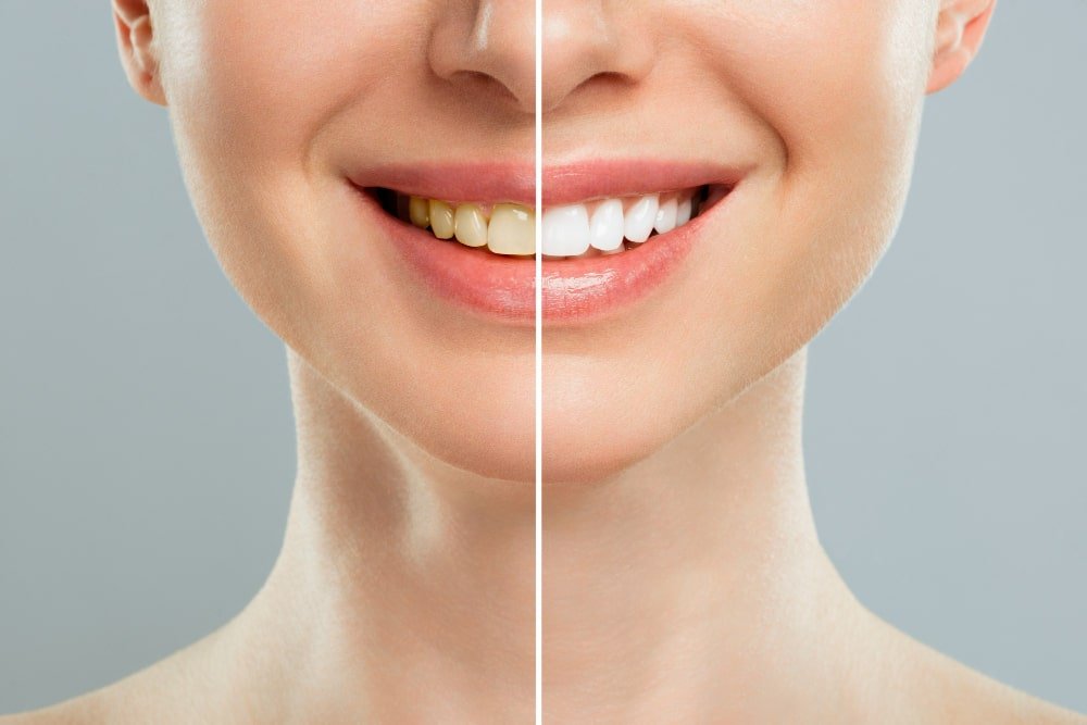 Teeth whitening in Lucknow