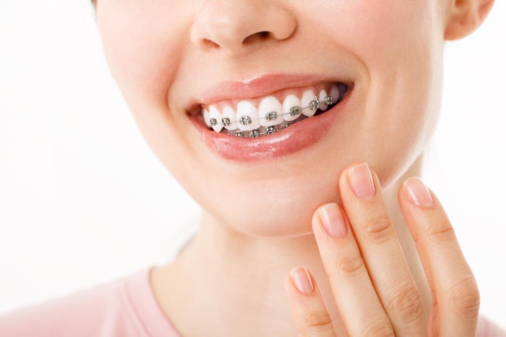 Braces and aligners in Lucknow