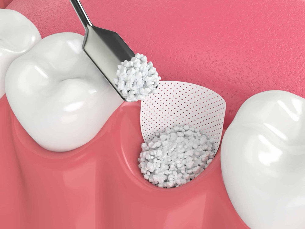 Full mouth dental implants