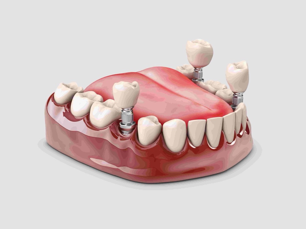 Multiple teeth dental implants