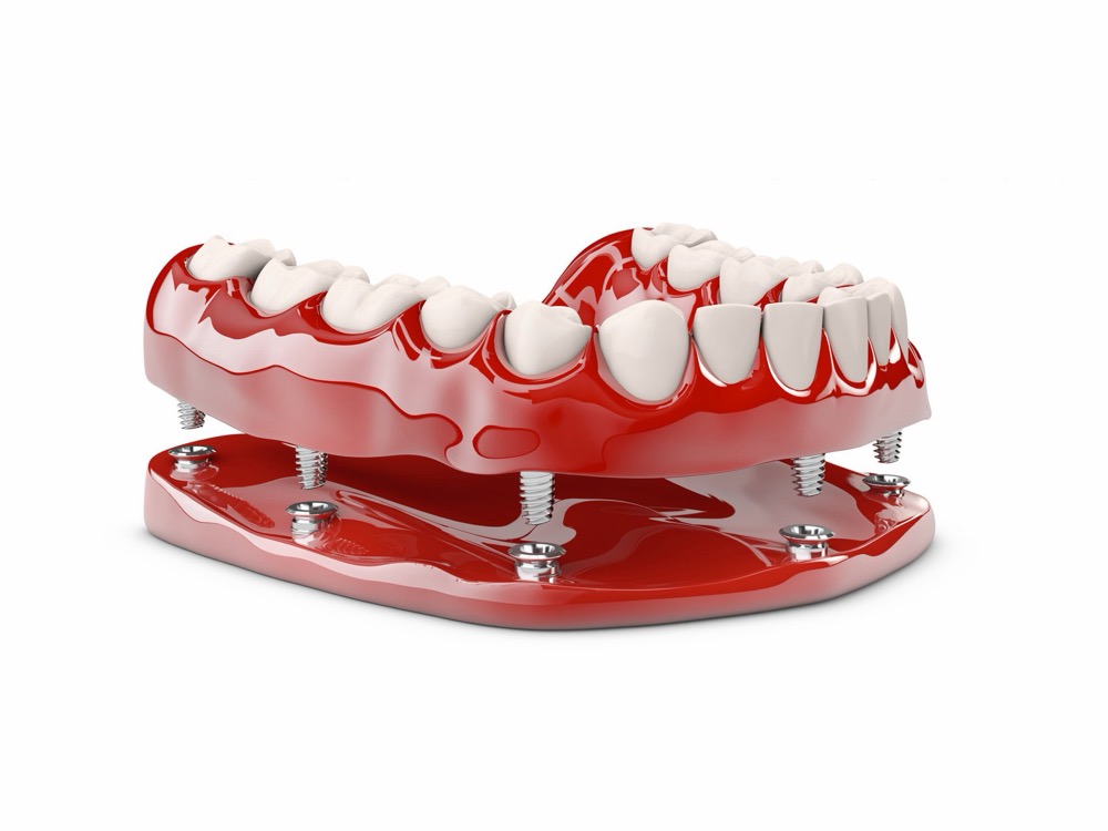 Dental implants in Lucknow