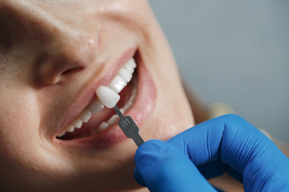 Cosmetic dentistry in Lucknow